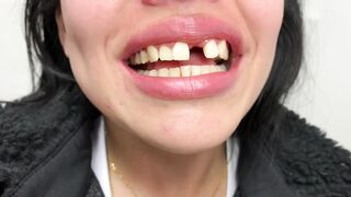 DENTAL PROSTHESIS FLEXIBLE ????