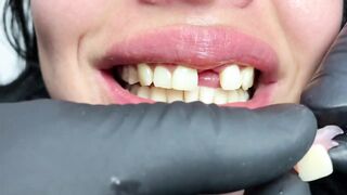 DENTAL PROSTHESIS FLEXIBLE ????