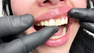 DENTAL PROSTHESIS FLEXIBLE ????