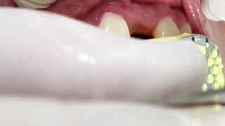 DENTAL PROSTHESIS FLEXIBLE ????