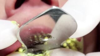 DENTAL PROSTHESIS FLEXIBLE ????