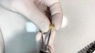 DENTAL PROSTHESIS FLEXIBLE ????